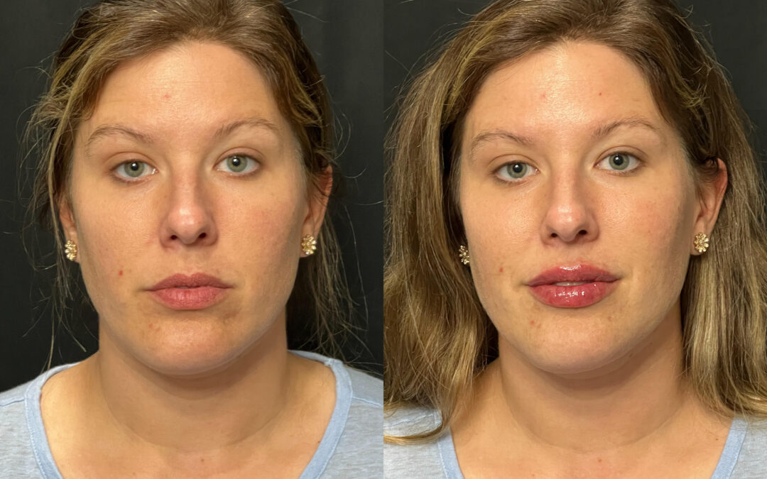 Fillers before and after photo by Radiance Medspa in Belleair Bluffs, FL