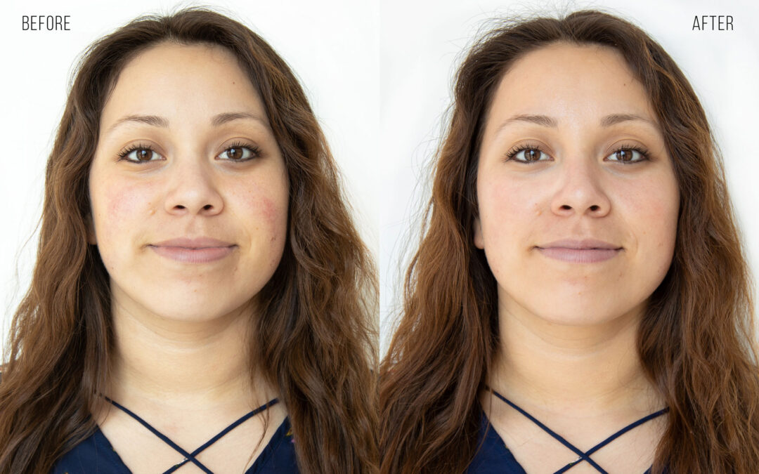 HydraFacial® before and after photo by Radiance Medspa in Belleair Bluffs, FL