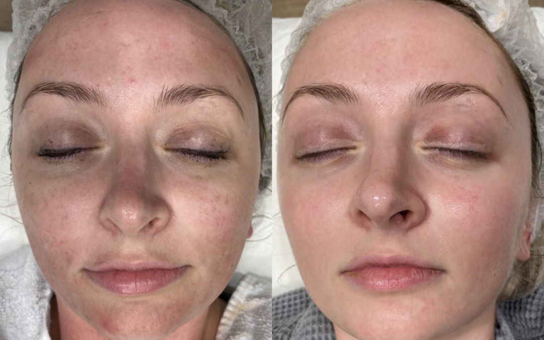 BBL Hero before and after photo by Radiance Medspa in Belleair Bluffs, FL
