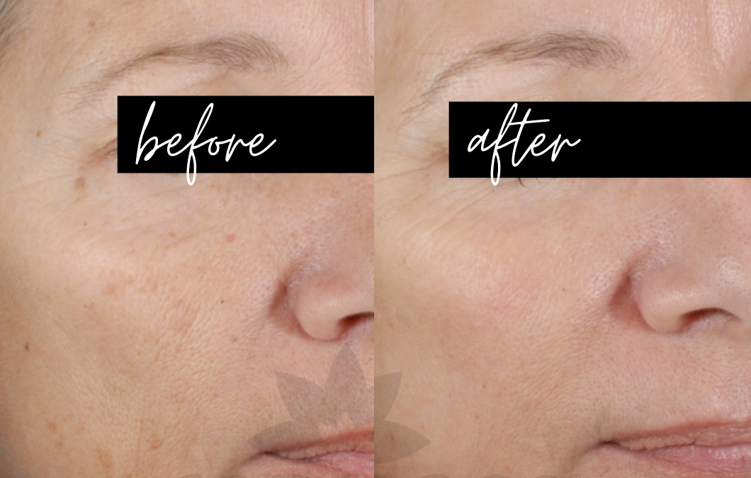 CoolPeel® CO Laser Resurfacing before and after photo by Radiance Medspa in Belleair Bluffs, FL