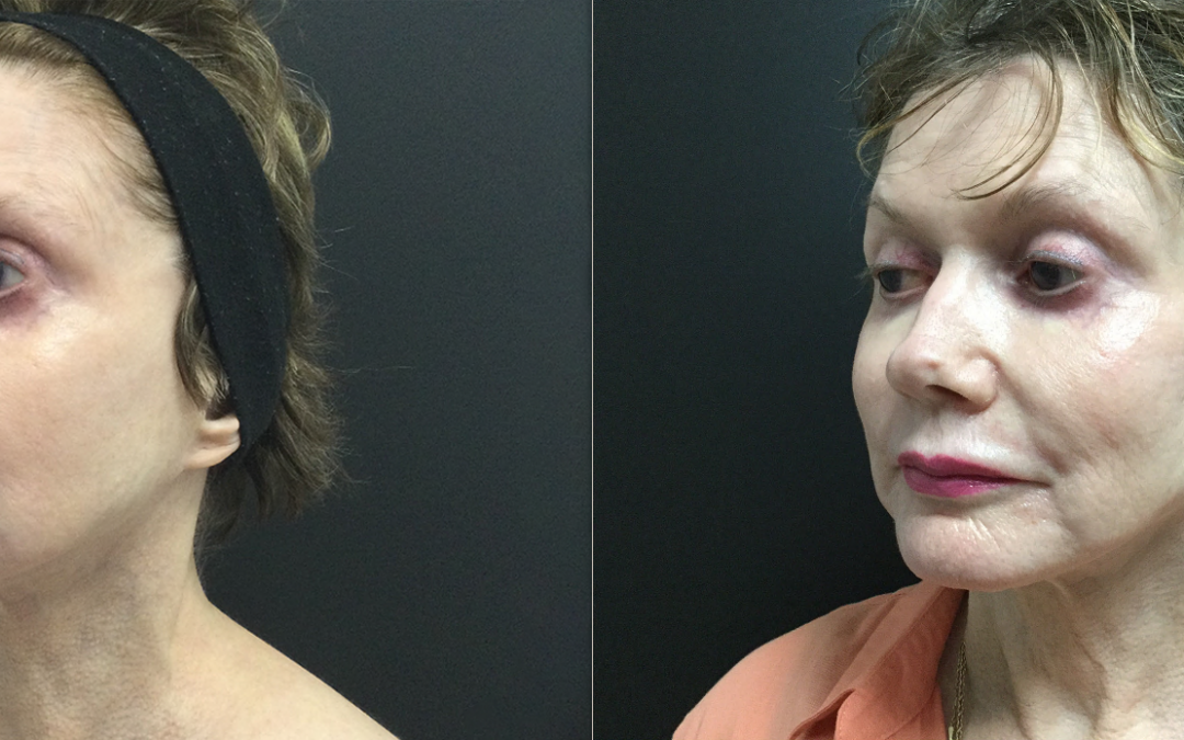Vivace™ Microneedling before and after photo by Radiance Medspa in Belleair Bluffs, FL