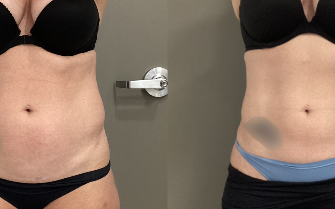 CoolSculpting® before and after photo by Radiance Medspa in Belleair Bluffs, FL