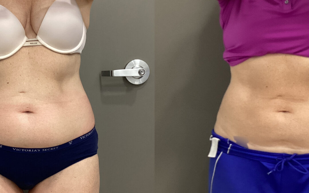 CoolSculpting® before and after photo by Radiance Medspa in Belleair Bluffs, FL