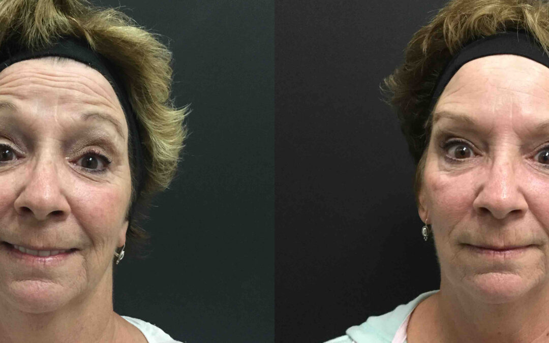 BOTOX® before and after photo by Radiance Medspa in Belleair Bluffs, FL