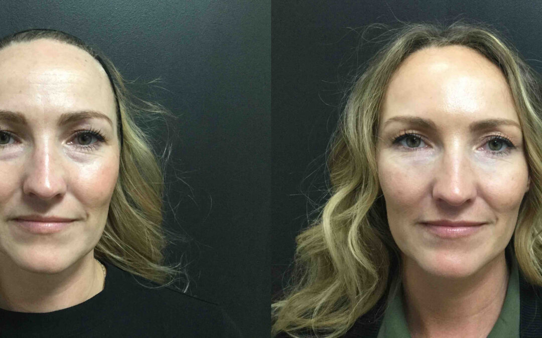 BOTOX® before and after photo by Radiance Medspa in Belleair Bluffs, FL