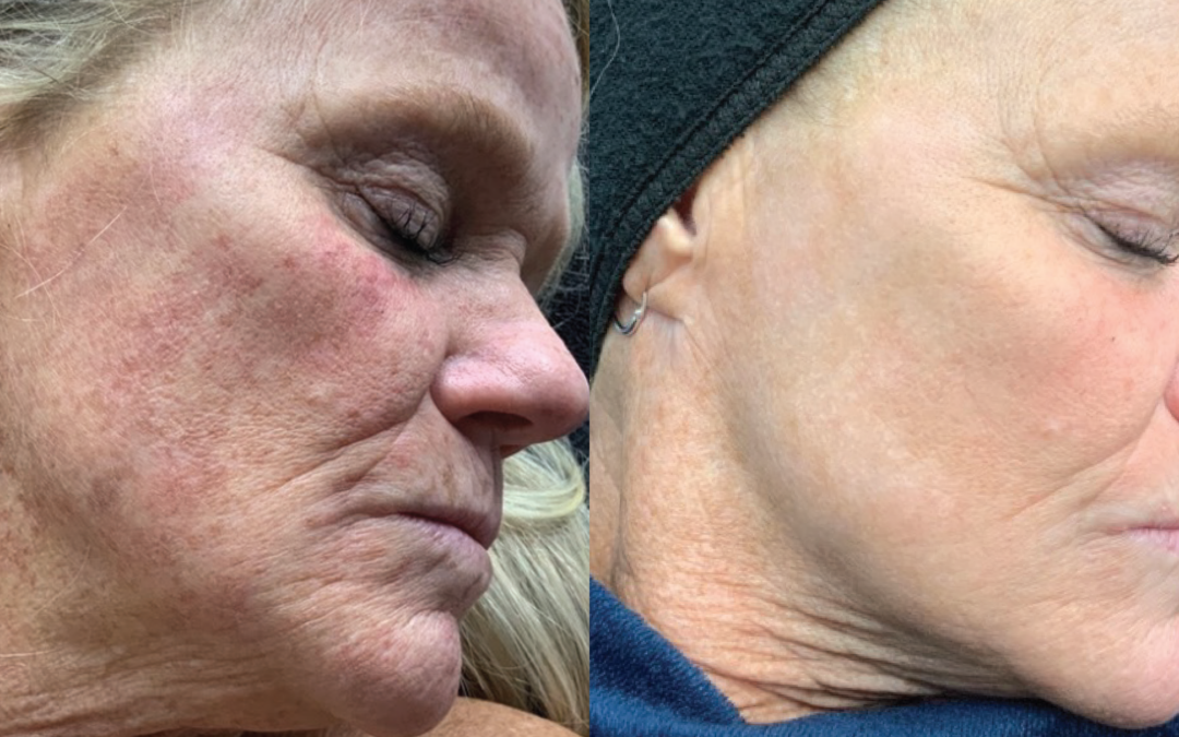 BBL Hero before and after photo by Radiance Medspa in Belleair Bluffs, FL