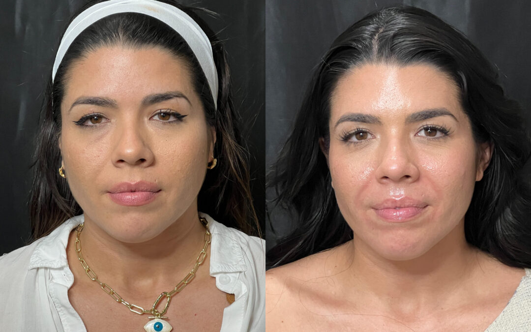 WiQo PRX Derm Perfexion before and after photo by Radiance Medspa in Belleair Bluffs, FL