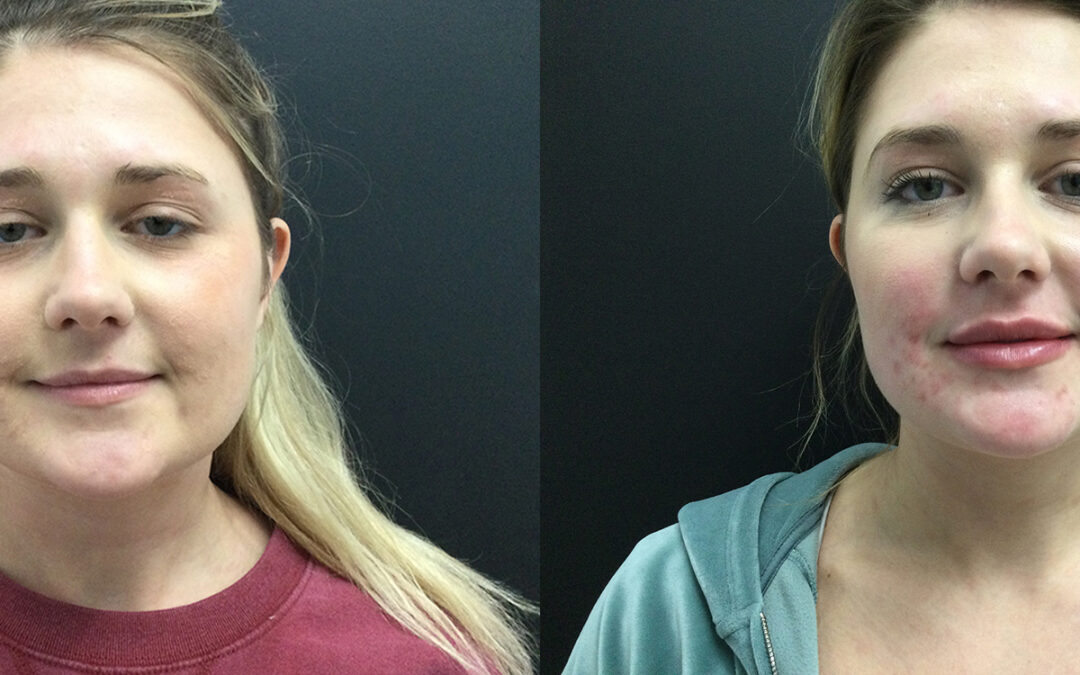 Fillers before and after photo by Radiance Medspa in Belleair Bluffs, FL