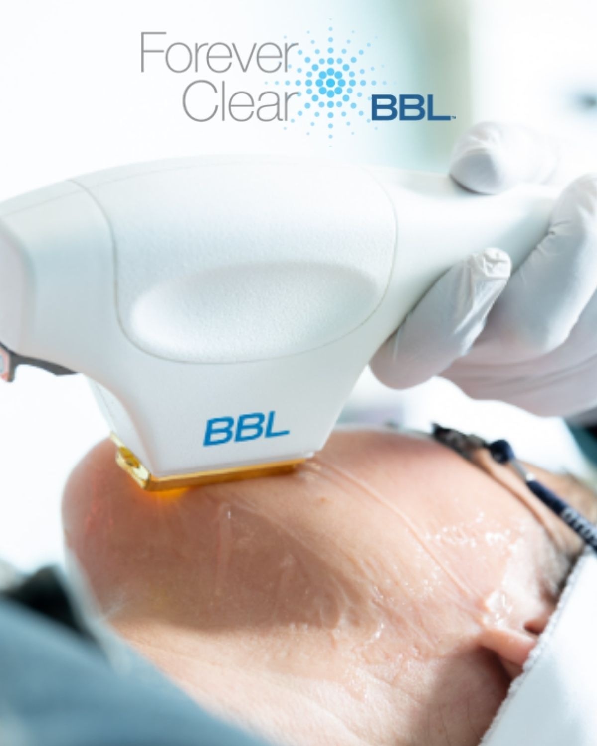 BBL-forever-clear-procedure-in-belleairbluffs-fl