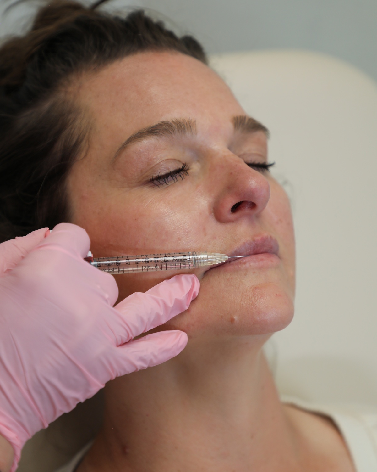 juvederm-fillers-in-belleairbluffs juvederm-fillers-in-belleairbluffs